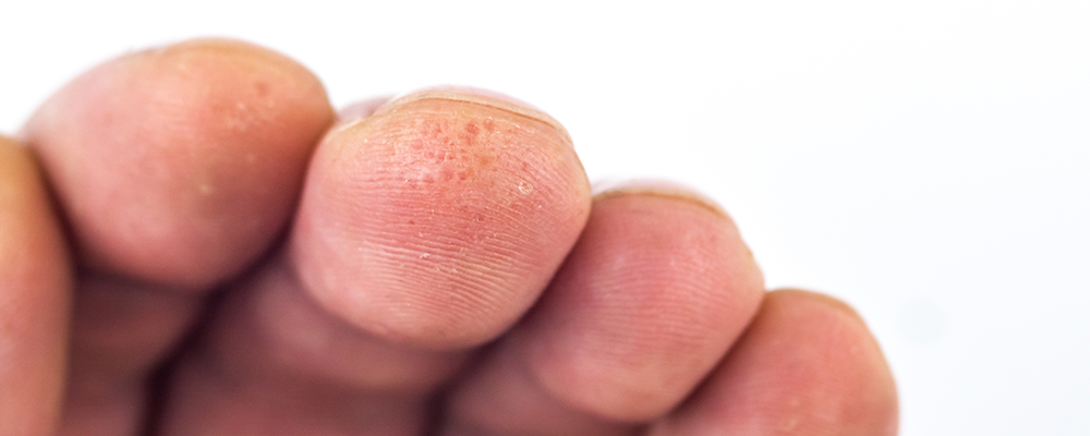 gloves dermatitis