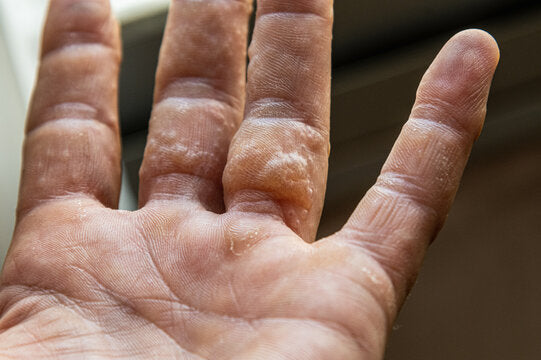 Skin irritation allergy & Hand Injuries Caused by Disposable Gloves